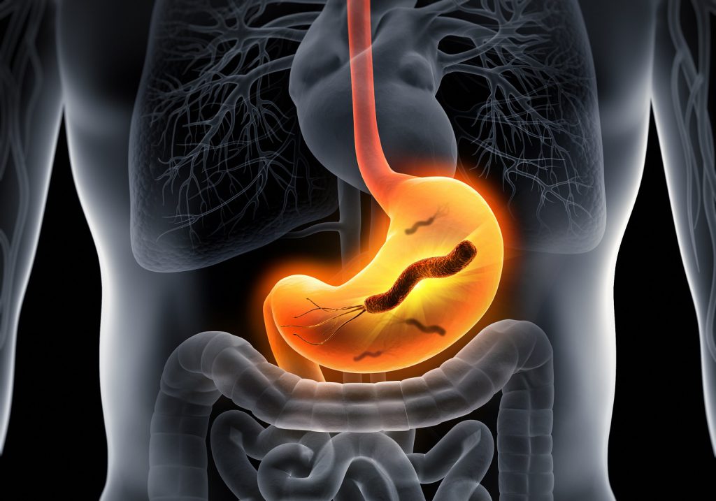 Helicobacter-pylori-H-pylori-Stomach-Infection