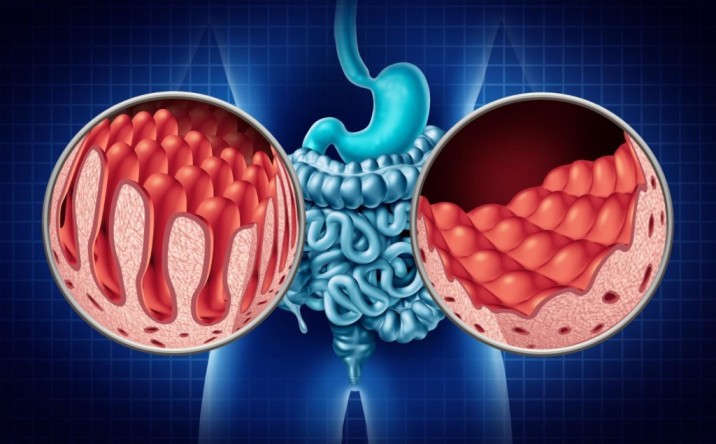 Celiac Self-Test Kits